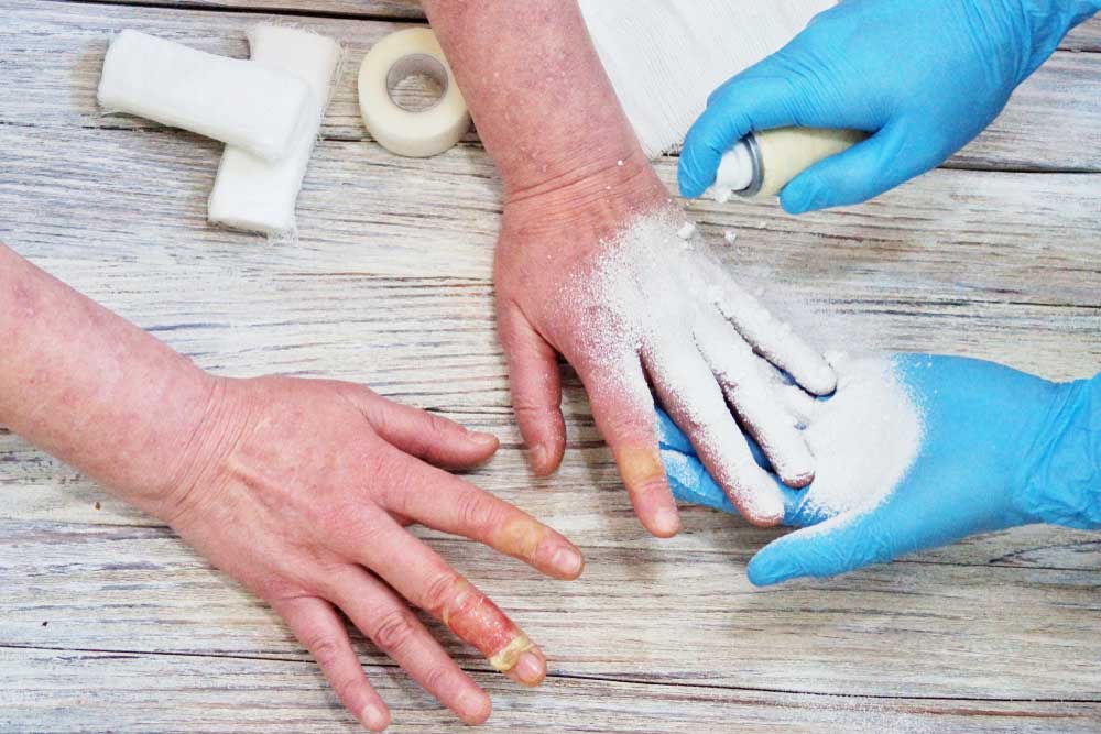 Хлађење као прва линија одбране код блажих опекотина